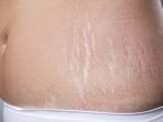 ilustrasi-stretch-mark_20180929_223230.jpg