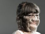 kenali-sindrom-werewolf-atau-hypertrichosis-pada-anak_20180105_100203.jpg