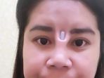 operasi-hidung_20180103_123342.jpg