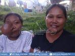 penderita-tumor-asal-sangihe-ucapkan-terima-kasih-bagi-gubernur-olly-dondokambey-dan-steven-kandouw.jpg