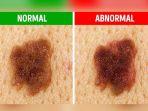 perbedaan-tahi-lalat-dan-melanoma-5215.jpg