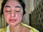 dewi-perssik-positif-coronaaa.jpg