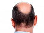 ilustrasi-rambut-botak.jpg