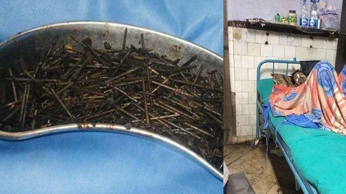 ANEH, 600 Lebih Paku dalam Perut Pria Ini, tak Satu pun Menusuk, Begini Penjelasan Dokter