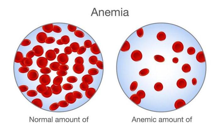 Mengenal Anemia Aplastik, Penyakit Langka yang Menyerang Babe Cabita