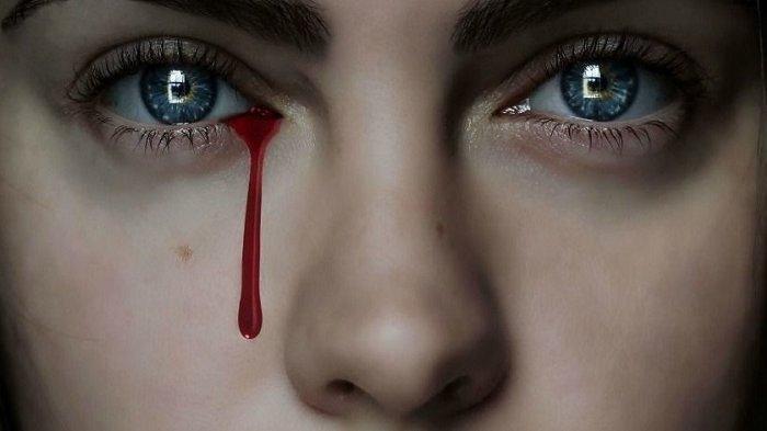 Alami Kelainan Langka, Wanita ini Menangis Darah dari Mata selama Menstruasi, Dokter Ungkap Penyebab