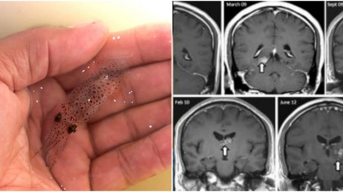 Menyeramkan, 7 Binatang Ini Pernah Hidup dalam Tubuh Manusia