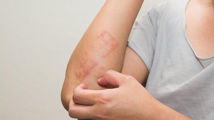 Kenali Eksim pada Wanita, Hingga Penyebab dan Cara Mengatasinya
