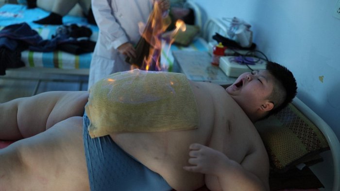 Begini Terapi Ekstrem Bocah Berpenyakit Langka Berbobot 150 Kg, Hasilnya. . .