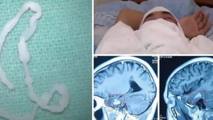 Ikhwalnya Memotong Katak lalu Remaja Ini Pusing, Teramat Mengagetkan saat Ditemukan Ini di Otaknya