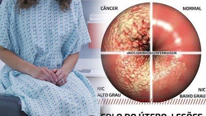 Ilustrasi perempuan hendak lakukan tes Pap Smear - Ilustrasi leher rahim wanita