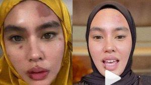 Penampakan-Wajah-Baru-Kartika-Putri-Sembuh-Usai-Berobat-ke-Singapura-Bantah-Kena-Penyakit-Ain.jpg
