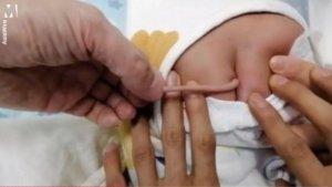 VIRAL-Bayi-Lahir-dengan-Ekor-Tumbuh-di-Pantat-Sepanjang-10-cm-Kasus-Langka-Ini-Penjelasan-Dokter.jpg