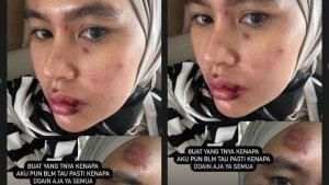 Wajah-Hingga-Mulut-Kartika-Putri-Melepuh-Kini-Berobat-ke-Luar-Negeri-Udah-Mulai-Capek-Sama-Jarum.jpg