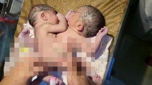 bayi-kembar-siam-Asahan.jpg