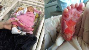 bayi-luka-lepuh-cek-stunting.jpg