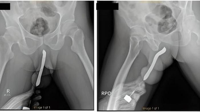 PRIA di Jawa Timur Masukan Sikat Gigi ke Penis Demi Kepuasan Bercinta, Berujung Bengkak Membiru