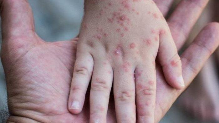 flu-SIngapura-merebak-di-Kabupaten-Batang.jpg