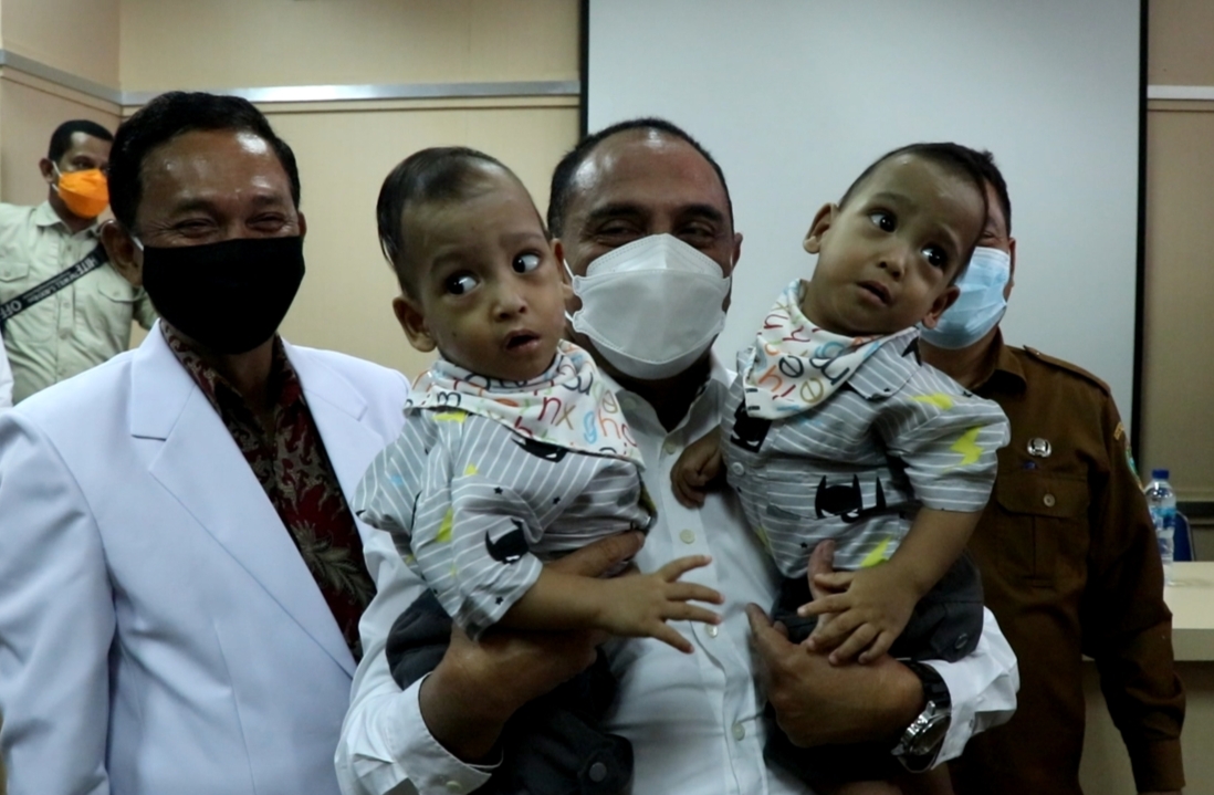 Semringahnya Gubernur Edy Rahmayadi Gendong Bayi Kembar Siam Adam dan Aris: Udah untuk Saya Aja Ya