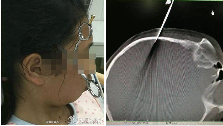 Tiru Adegan di Film, Bocah Lelaki Lempar Gunting ke Kakaknya, Nancap di Kepala Sedalam 2,5 CM