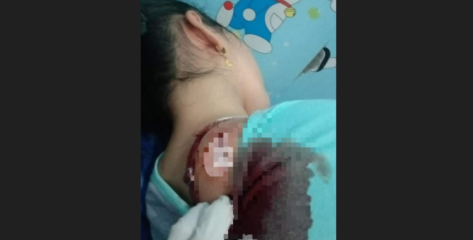 HATI-HATI! Begal di Percut Nyamar Jadi Pencari Rumput, Seorang Wanita Kena Celurit