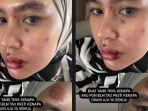 Wajah-Hingga-Mulut-Kartika-Putri-Melepuh-Kini-Berobat-ke-Luar-Negeri-Udah-Mulai-Capek-Sama-Jarum.jpg