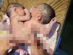 bayi-kembar-siam-Asahan.jpg
