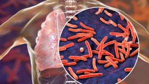 Ilustrasi-Penyakit-Tuberkulosis.jpg