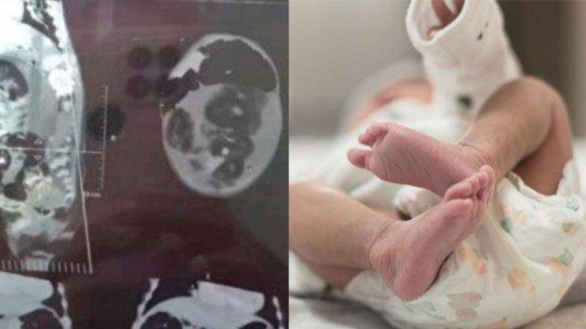 Bayi Usia 5 Bulan Perutnya Buncit Aneh, Dikira Kembung Ternyata 'Hamil' Kembarannya Sendiri