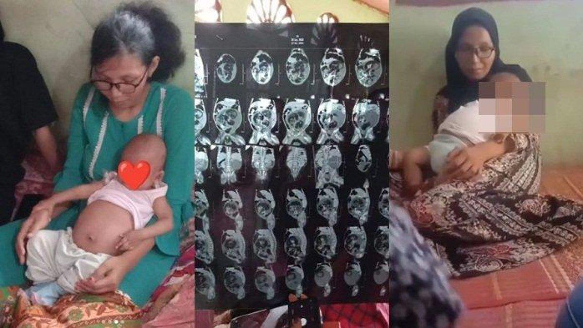 TERJAWAB! Bayi 5 Bulan di Padang yang Perutnya Membengkak, Bukan Hamil tapi Tumor 2 Kg: Dibedah