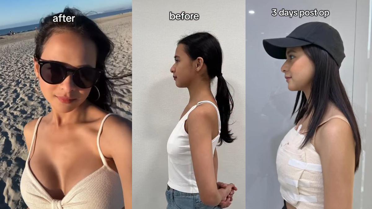 OPERASI PAYUDARA ARTIS - Perjalanan operasi payudara Cathy Fakandi.