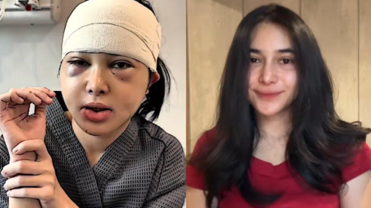 TRANSFORMASI DILAN JANIYAR - Potret Dilan Janiyar diambil dari Instagram, Rabu (16/4/2025). Penampilan Dilan Janiyar setelah oplas.