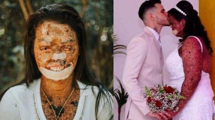 CINTANYA Tulus Tak Pandang Fisik, Pria Ini Menikahi Kekasihnya yang Alami Kelainan Kulit Langka