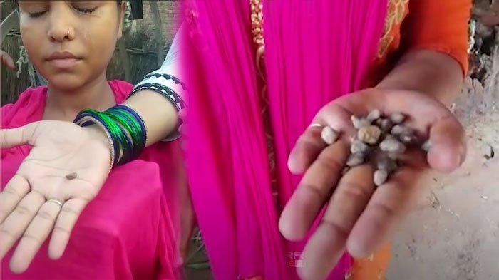 Bukan Air Mata, Gadis Ini Keluarkan Batu dari Kelopak Matanya, Terkumpul 70 Butir, Ini Kata Dokter