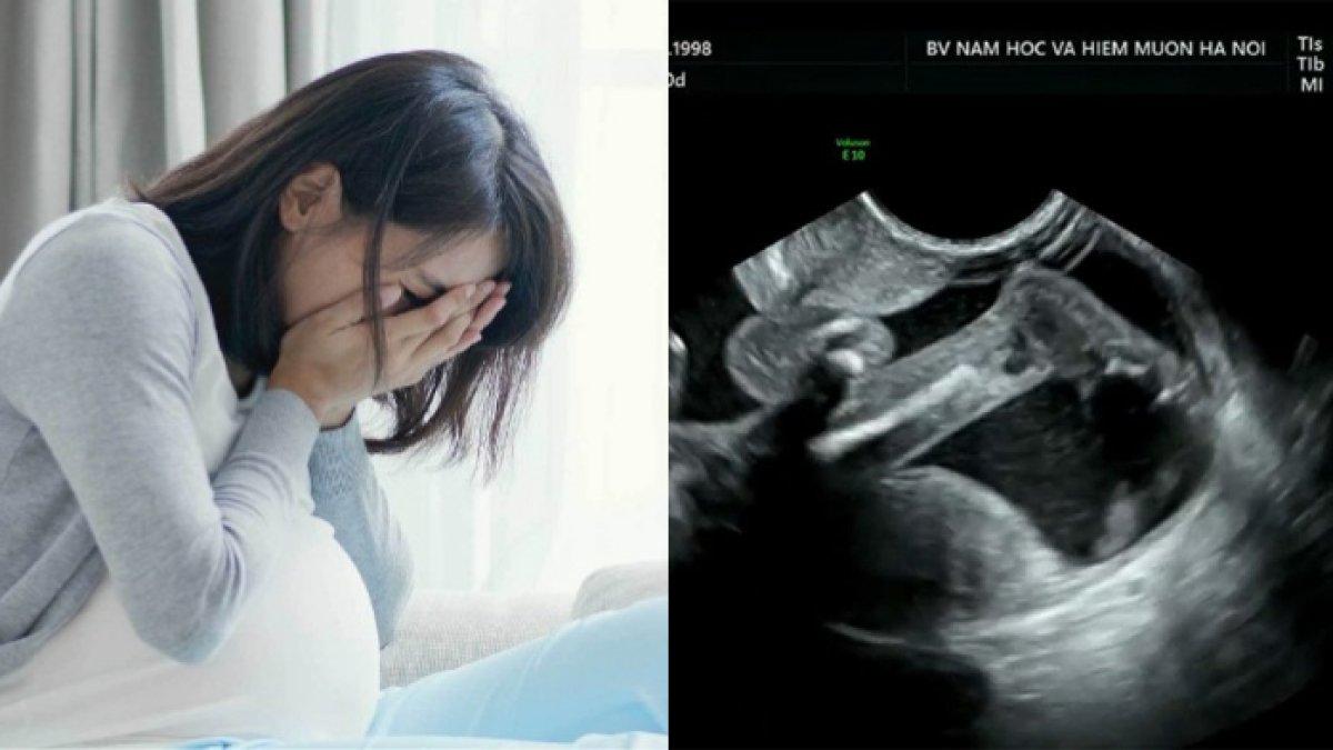 ASTAGHFIRULLAH Baru Hamil 4 Bulan, Wanita Syok Kaki Bayinya Sudah Mencuat Keluar, Kondisinya Gawat