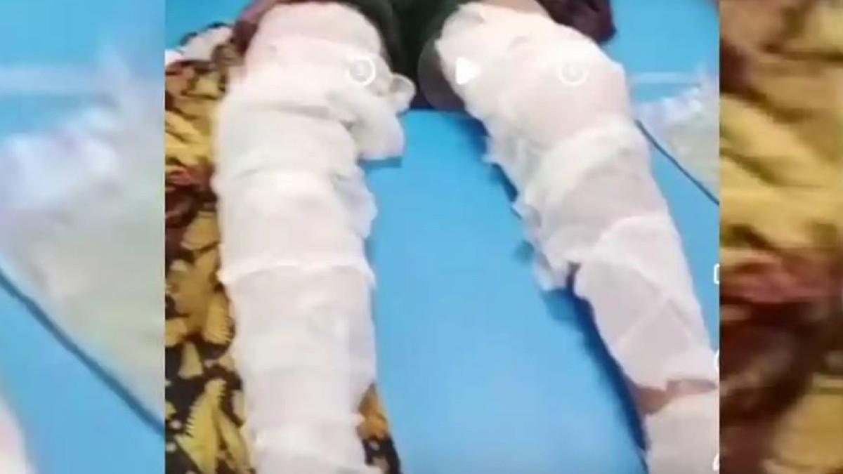 KEKERASAN DI PONPES - Tangkapan layar kaki salah satu korban dugaan pembakaran di lingkungan pondok pesantren di Lombok Tengah. LPA Kota Mataram mendalami dugaan pembakaran terhadap tiga santri di sebuah pondok pesantren di Lombok Tengah yang disebut terjadi pada November 2025.