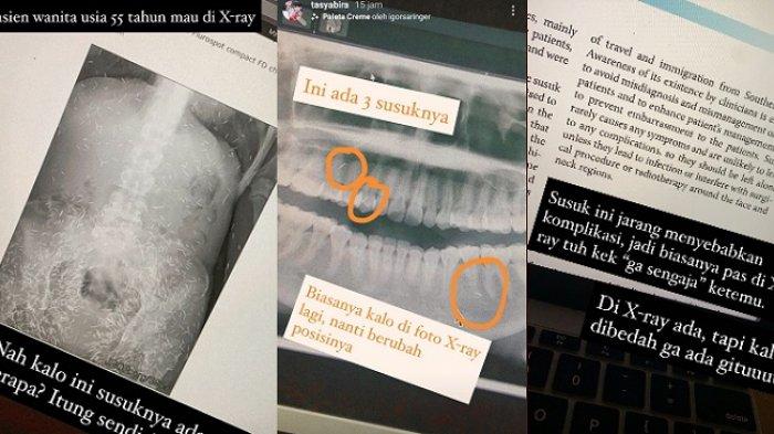SERAM Foto X-Ray Wanita Diduga Pakai Susuk Seperti Dipenuhi Belatung, Dokter Sebut Kerap Terjadi