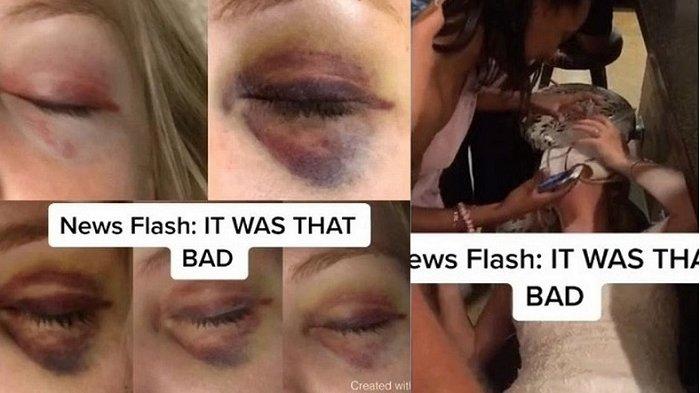 Gara-gara Insiden Tak Terduga, Mempelai Wanita Tergeletak Masih Pakai Gaun Pengantin, Matanya Lebam