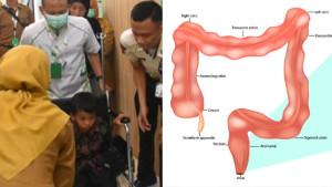Kisah-Alif-Nur-Cahya-bocah-Sumedang-tanpa-anus.jpg