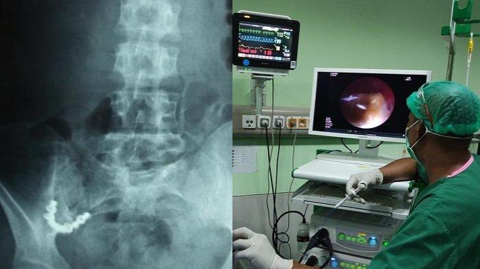 SYOK! 15 Tahun Nyangkut di Paru-paru, Gigi Palsu Warga Aceh Sulit Dikeluarkan: Lengket di Organ