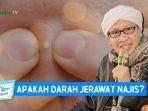 Apakah-darah-dari-jerawat-itu-juga-termasuk-najis.jpg