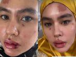 Kondisi-Kartika-Putri-saat-penyakit-autoimun-aktif-12.jpg