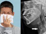 Tenggorokan-pria-ini-robek-gegara-menahan-bersin.jpg