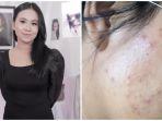 kapok-pakai-skincare-mayang-pilu-wajah-gagal-mulus-kini-malah-dipenuhi-jerawat.jpg