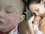 kondisi-terkini-anak-keempat-mona-ratuliu-yang-idap-dermatitis-atopik.jpg