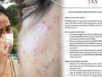nasib-apes-mayang-curhat-wajah-rusak-kini-malah-dituntut-pohak-skincare.jpg