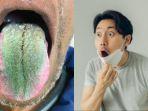 pria-ini-syok-tiba-tiba-lidahnya-berubah-warna-menjadi-hijau-dan-berbulu2.jpg
