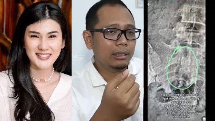 Dokter Akhirnya Ungkap Jenis 'Benda Asing' Hasil Rontgen Tubuh Stevie Agnecya, Sengaja Dimasukkan?