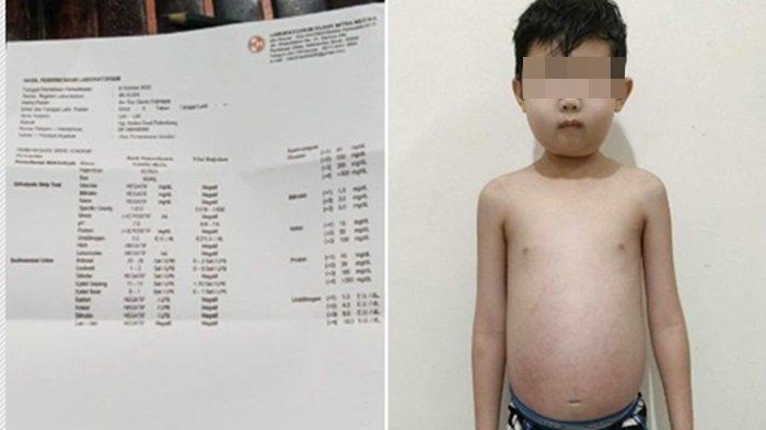Bocah 9 Tahun di Palembang Idap Ginjal Bocor Protein, Ibu Giovin Harapkan Uluran Tangan para Donatur