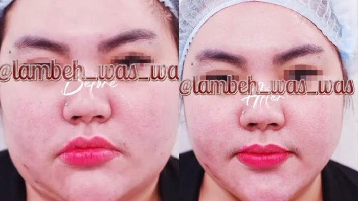 Penampilannya Dicap Berubah Drastis, Beredar Video Lisa Mariana Sedot Lemak, Wajahnya Mendadak Tirus